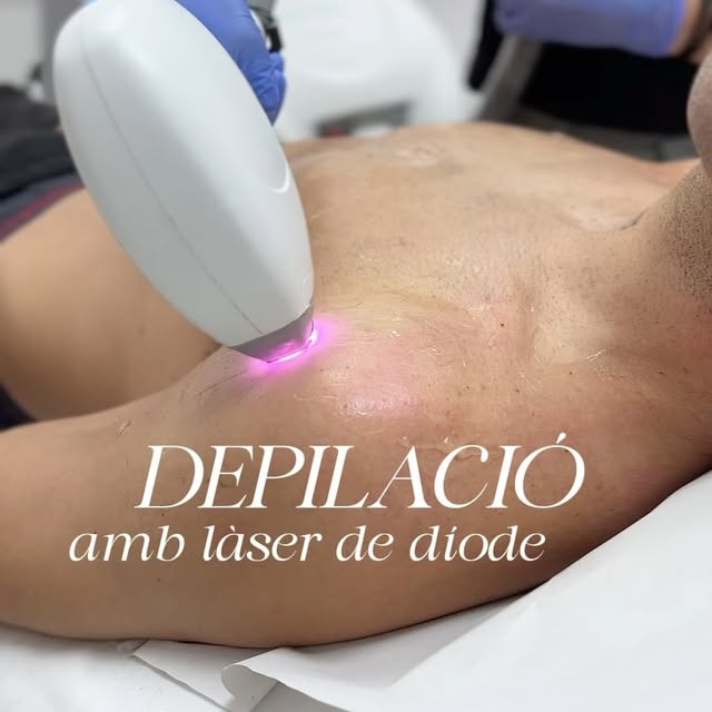 DEPILACIO LASER DIODE